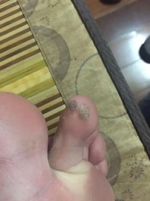 脚上长了这样的肉刺很多.左脚有,右脚没有.这是啥病啊.