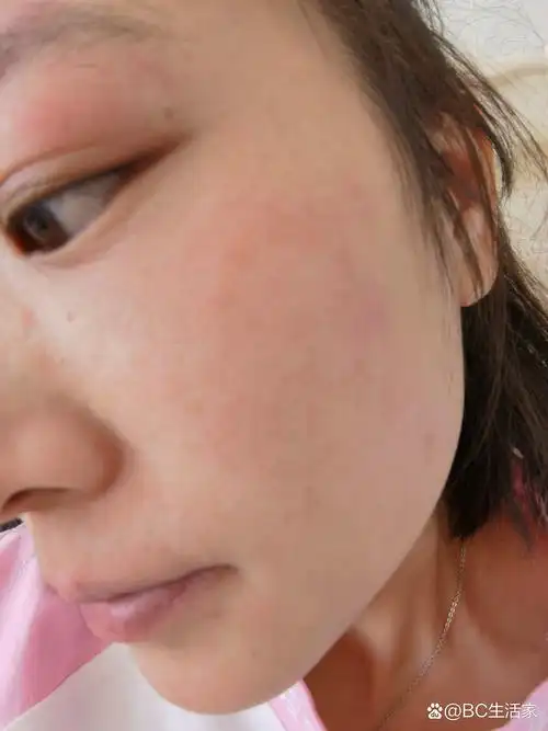 记录面部过敏裸脸第四天 今天皮肤状态,超级干燥,等待爆皮,左侧脸已经