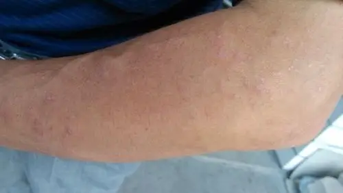 这种皮肤病是什么皮肤病?怎么治疗?