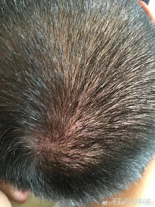 头皮毛囊炎6年治不好极度影响生活寻找相同情况的病友