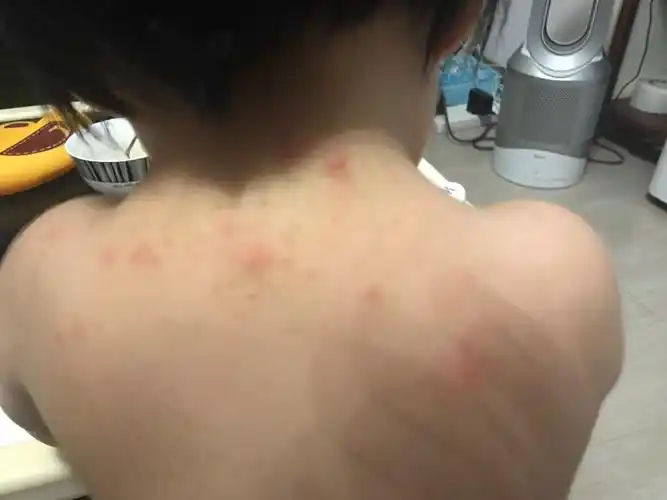 蓬医生孩子后背这两天突然起的小红包一开始以为是痱子可也