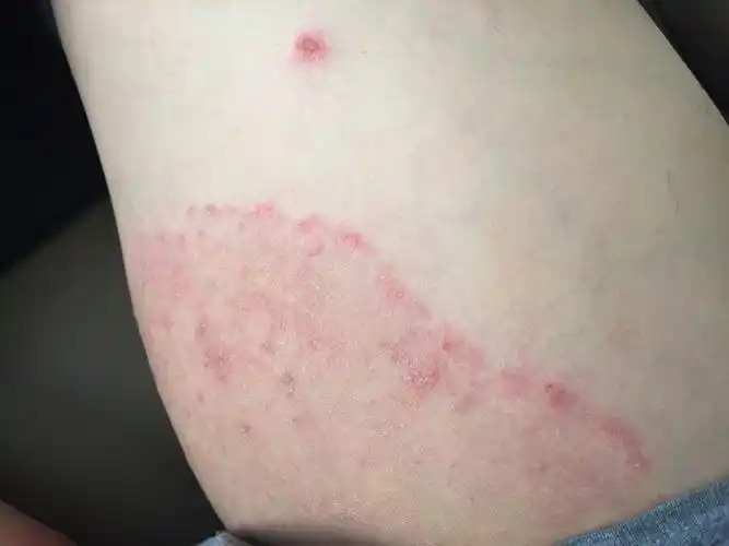 股癣到底有什么好办法医治啊?