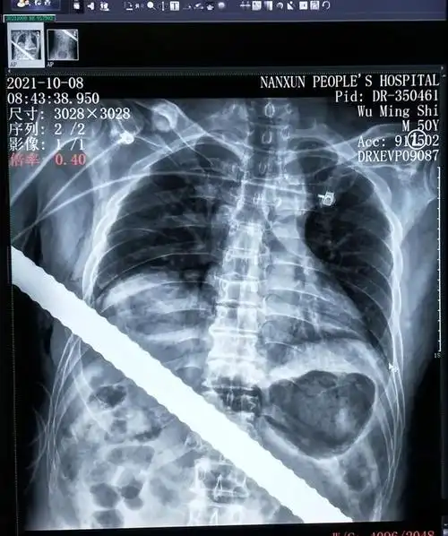 惊心动魄2小时!湖州男子被1米长钢筋刺穿胸腹