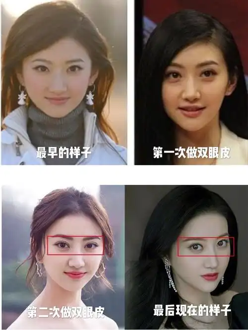 景甜的双眼皮曾经因为修复上了热搜,大家看了热搜里的_圈子-新氧美容