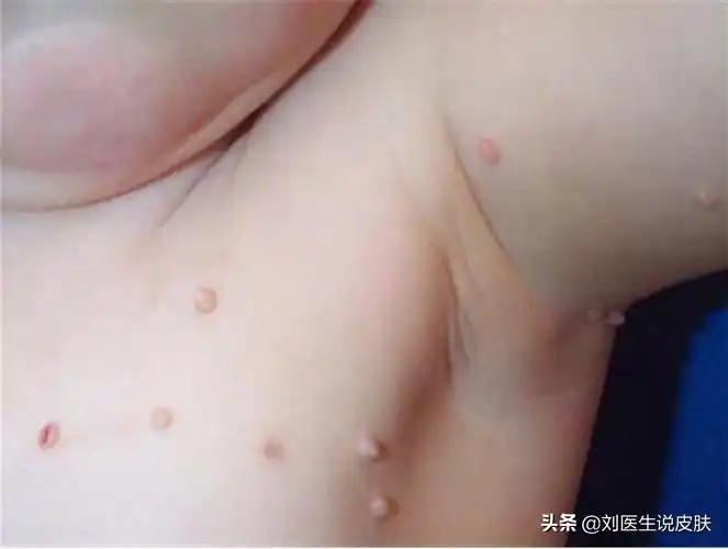 丝状疣,一般是由人 *** 瘤病毒感染所引起的,传染源为患者和病毒携带