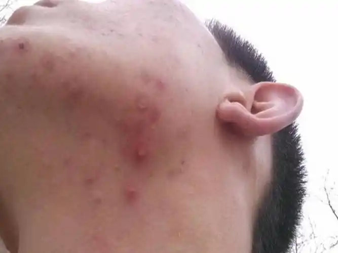 下巴下面痤疮图片的大全