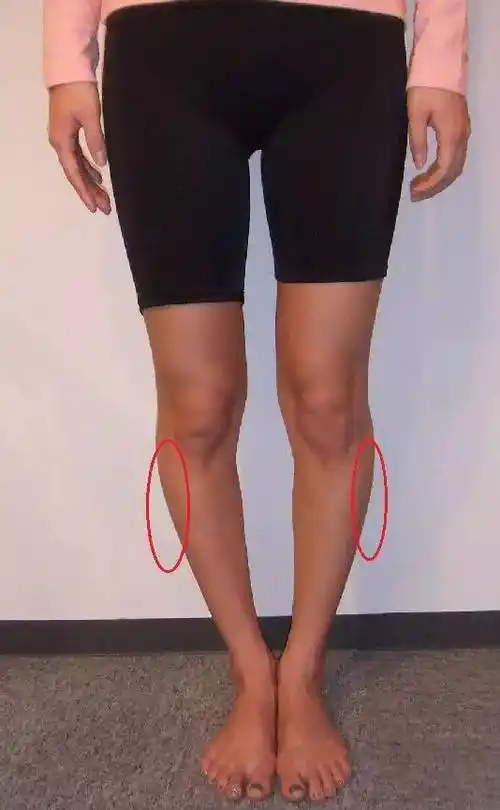 3,走路时足尖内旋,也就是我们通常所说的内八字脚