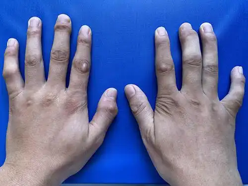 在x线下更能直观的看到痛风对手指骨头有虫蚀样骨质破坏