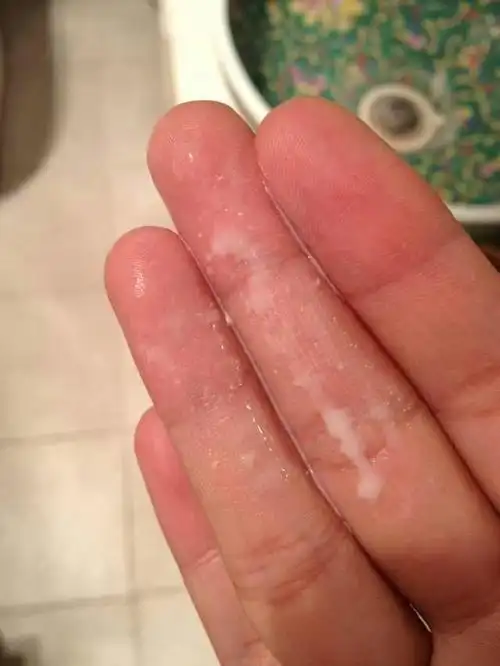 正常白带:呈白色糊状或蛋清样,高度粘稠,无腥臭