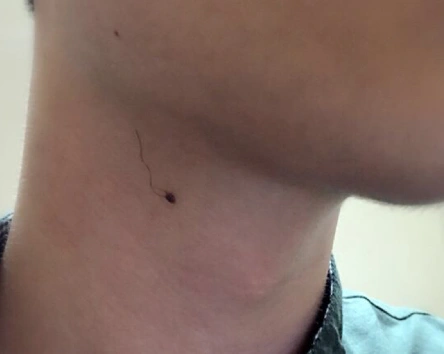 脖子右侧有颗痣上长毛会怎么样?