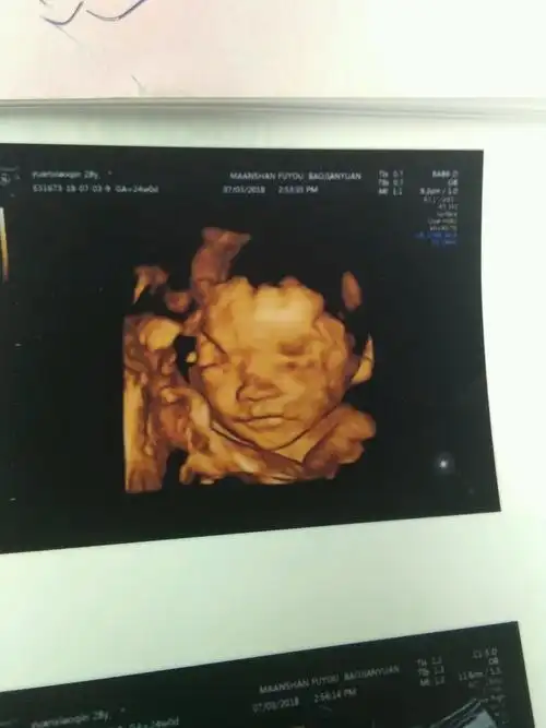 四维彩超宝宝特别配合非常清晰