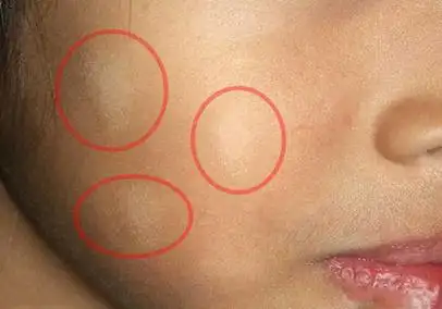 白色糠疹图片初期样子(娃脸上惊现白斑有虫) - 赤虎壹号