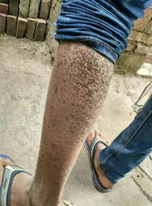 分享一个"鱼鳞病"的用药反馈