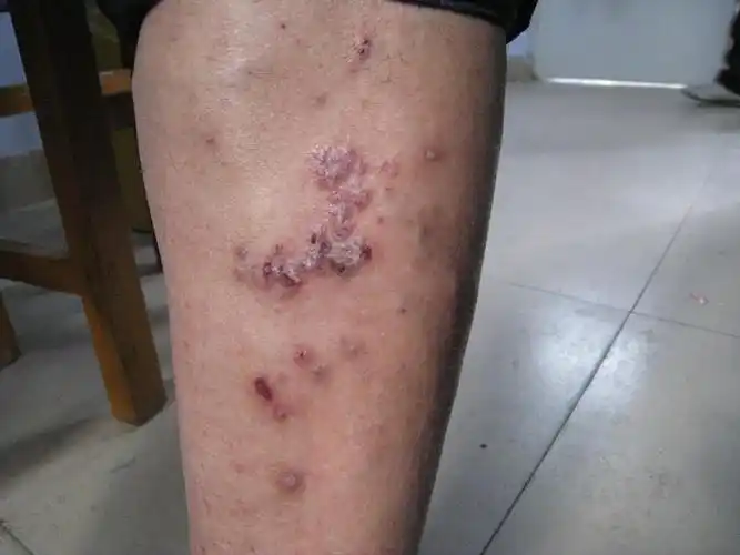 封闭治疗结节性痒疹效果好