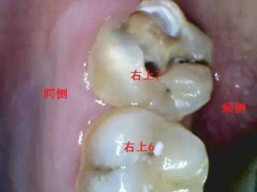 罕见的上颌第二磨牙腭侧双根管病例展示