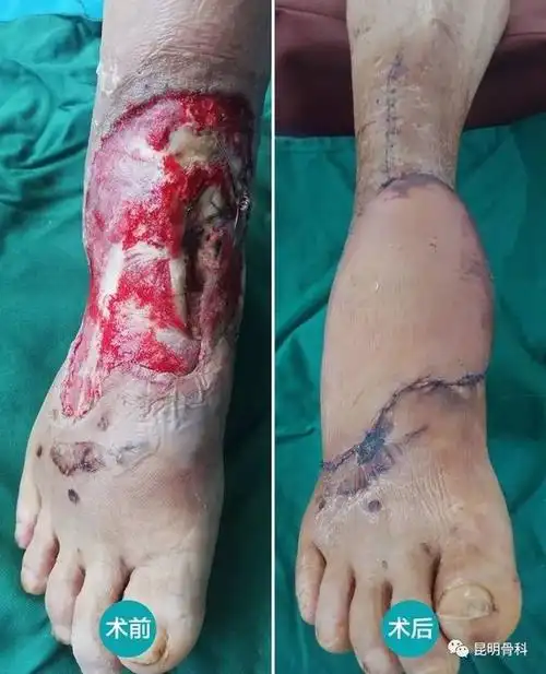 老汉遇车祸险遭截肢昆骨专家取皮瓣造新脚