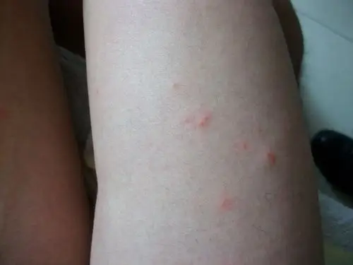 规矩!过敏性湿疹怎么治疗"男性不育"-第2张图片-追风博客