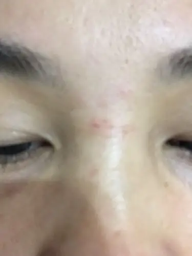 为什麼鼻梁上会长出一条横纹,还是一夜之间的