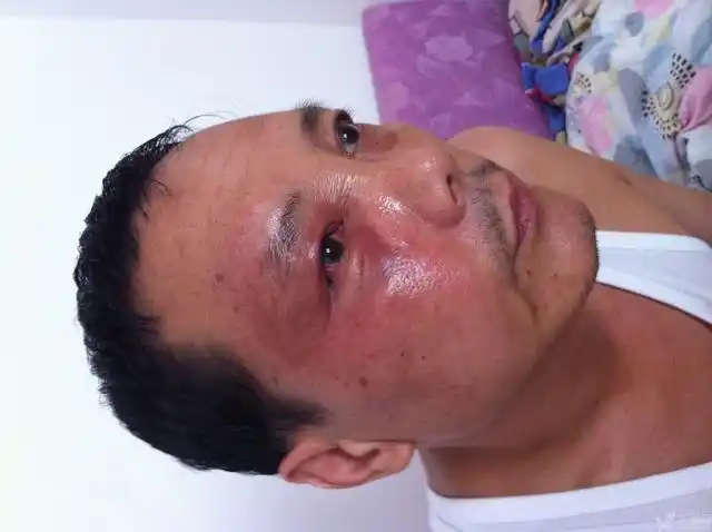 【求助】右侧脸部浮肿,有图片