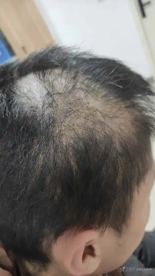 图片分享拔毛癖一例