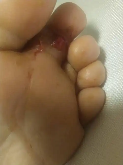 脚趾肿了流血一直不好