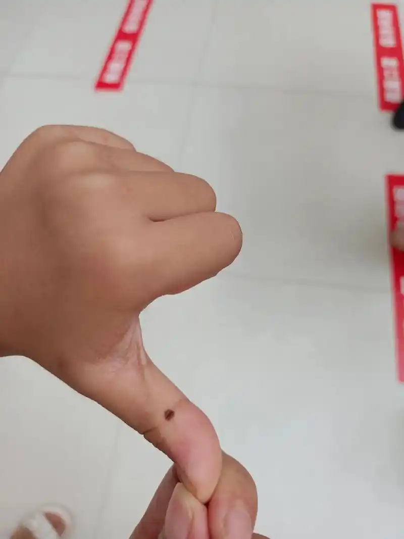 前两天发的孩子手上长了一颗痣,手术切掉了,有人多人关心.发现 - 抖音