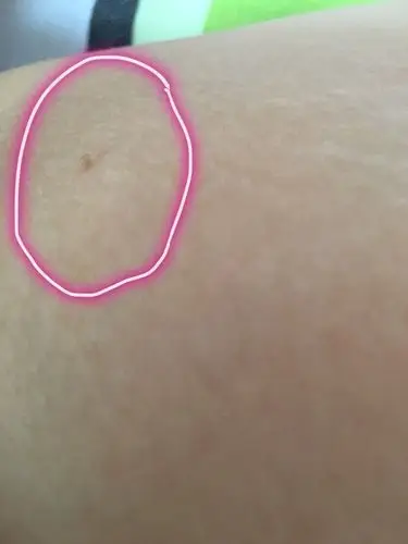 大腿内侧长了一颗小肉啾啾,不疼不痒,这是什么啊 ?