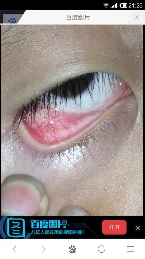 小孩下眼皮里面有很多似小水疱的小疙瘩,有点痒是怎麽回事_百度宝宝