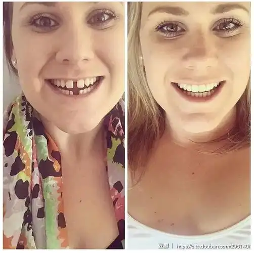 牙齿矫正前后对比图