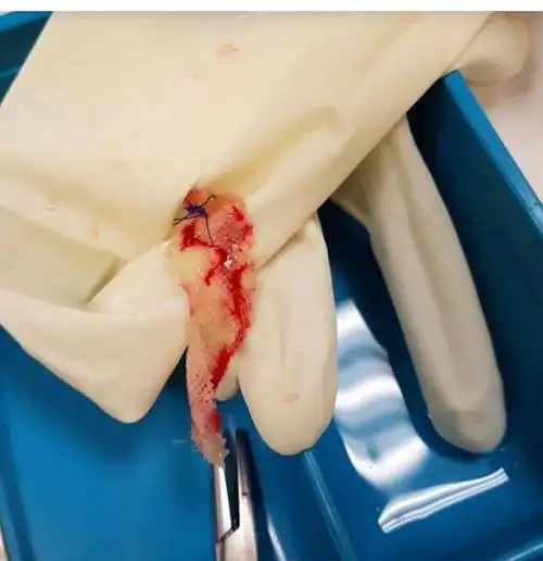 没办法,陈女士只能拆线将纱布拿出再重新缝合.