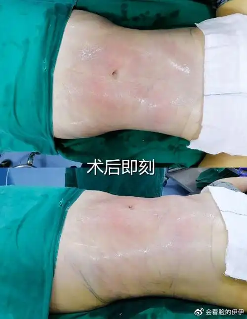 6767每个女生都希望自己瘦瘦的腰腹环吸会不会影响生孩子