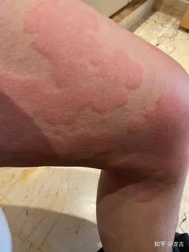 打新冠疫苗后 皮肤过敏