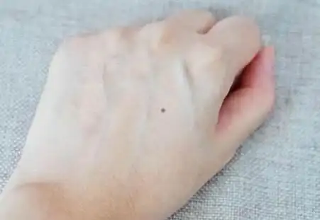 手背上长痣代表什么,手背上有痣代表什么