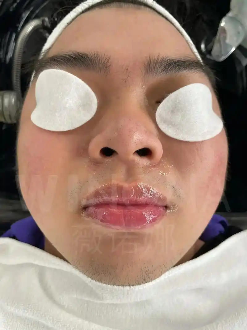 精致男孩 3次薇诺娜果酸换肤治疗对比#鸡皮肤 #好皮肤养成 - 抖音