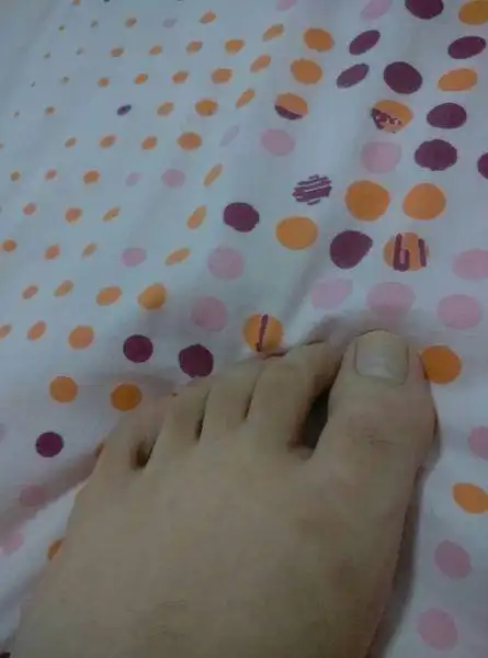 我的中脚趾有些弯曲,但不疼不影响跑步走路,可能是小时候出车祸造成的