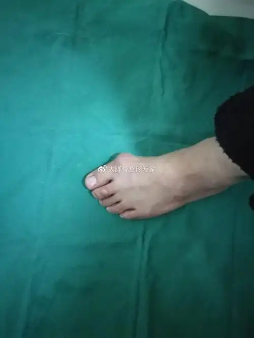 预防拇外翻的方法-怎么预防大脚骨