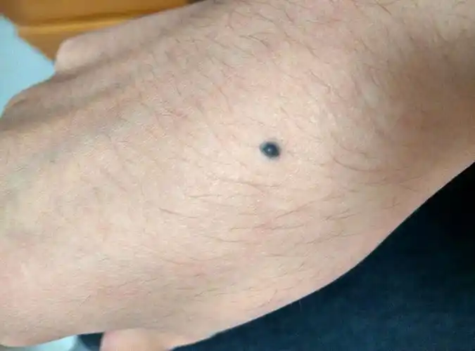 右手手背长了一个像是痣的东西小时候没有请问有没有人知道这是什么