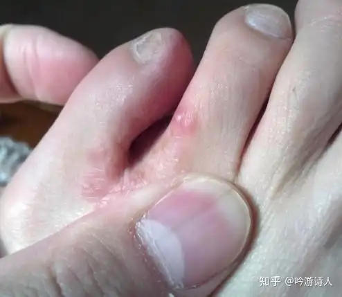 水泡型脚气是真菌感染所致,属于比较顽固的一种.