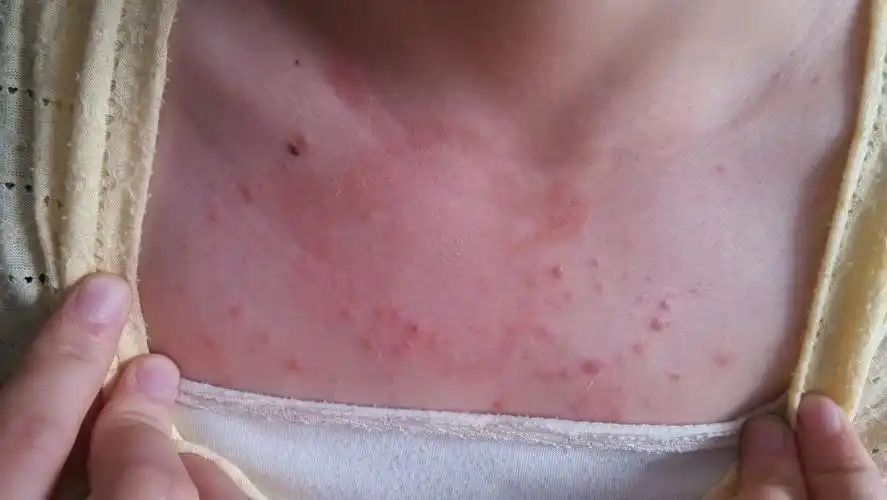 皮肤及性传播疾病讨论版 - 爱爱医医学论坛