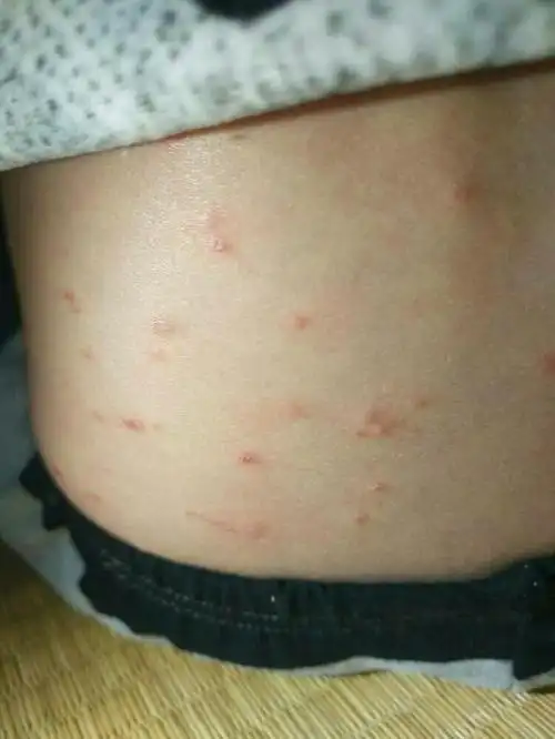 摩擦性苔藓样疹的患者,发病人群多为儿童,发病部位较多,别忽视