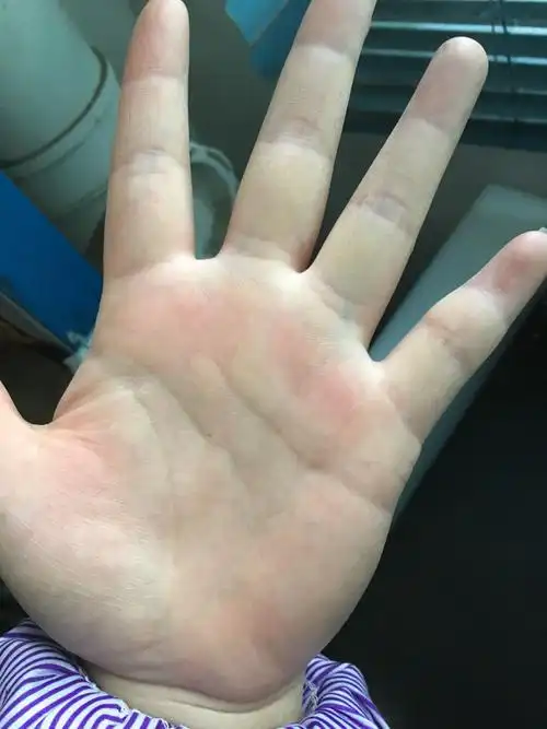 我的手掌最近出现好多青筋 特别是蹲着洗头 站起来后特别明显 这是