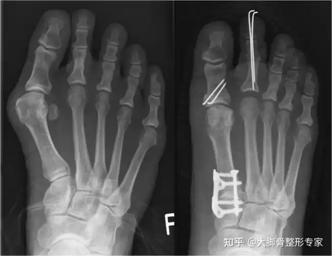 做大脚骨手术一定要上钢板吗微创效果佳恢复快