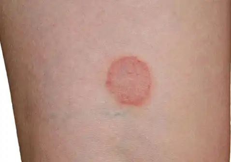 圆癣是一种发生在皮肤表层的真菌感染.