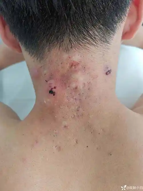 病例分享-看图识病,颈项部毛囊炎反复发作