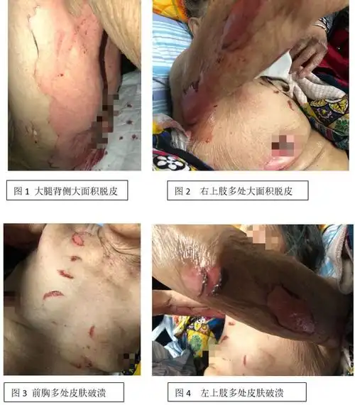 一例左氧氟沙星致大疱表皮松解坏死型药疹的护理