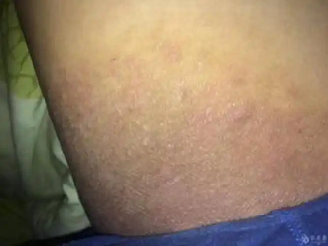 大腿外侧股癣 图片_有来医生