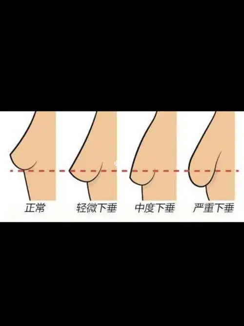 求解胸下垂方法