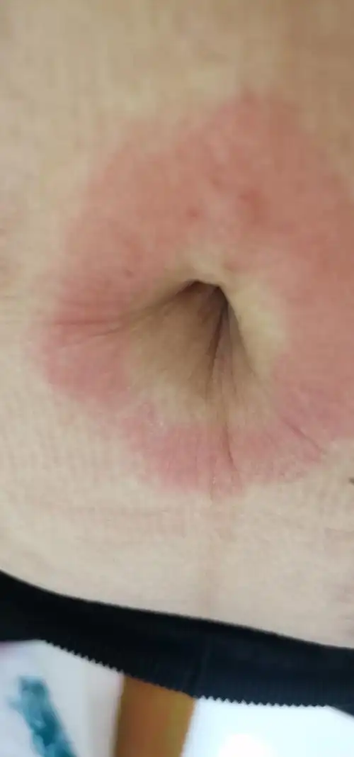 刚刚试纸测出怀孕35天左右肚脐周围过敏痒能抹