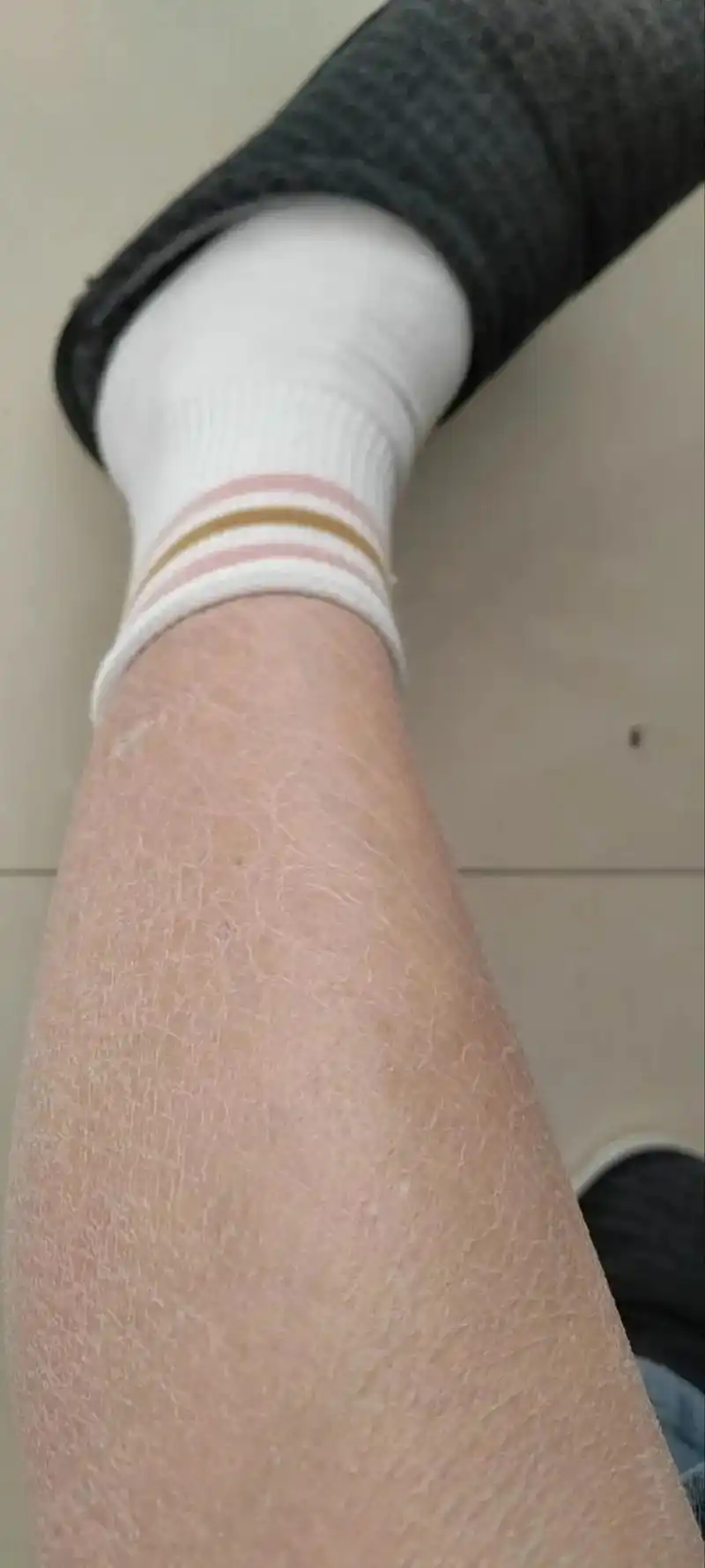 鱼鳞病鸡皮肤老人手的改变用鱼鳞皂鱼鳞膏日常洗澡皮肤就可以改变了