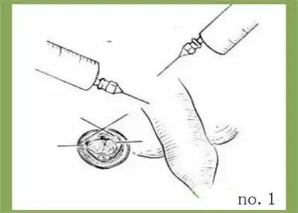 包皮过长手术的图解